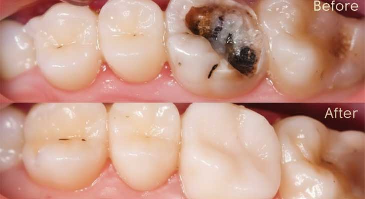 ترمیم کامپوزیت دندان