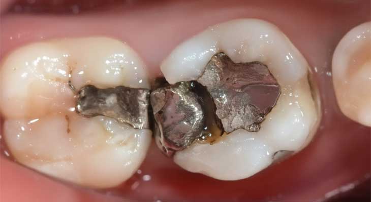 شکستگی دندان