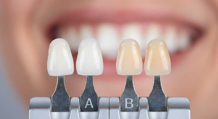 تفاوت رنگ لمینت دندان A و B