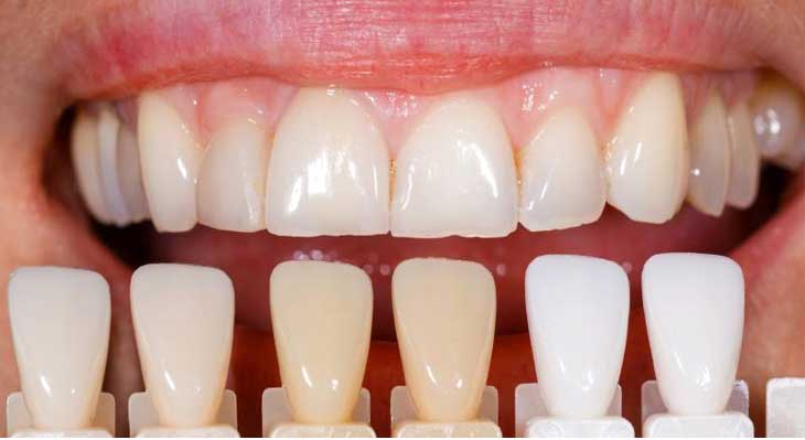 کامپوزیت بدون تراش دندان