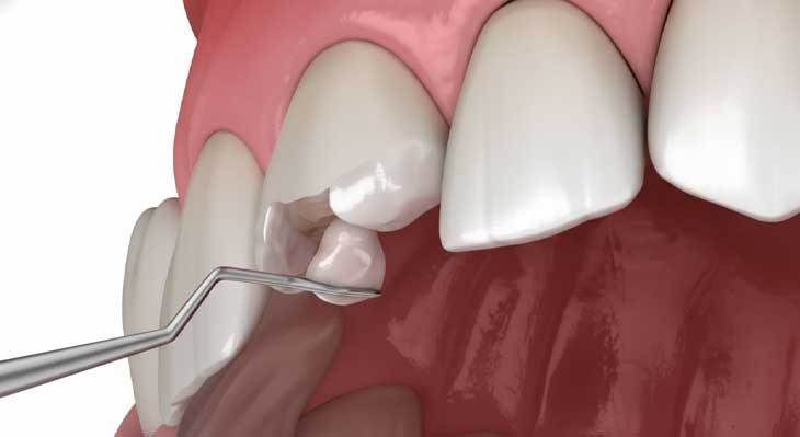 شکستن کامپوزیت دندان