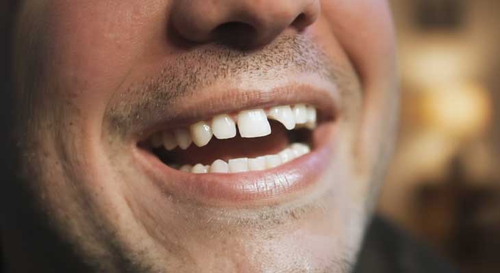 شکستگی دندان