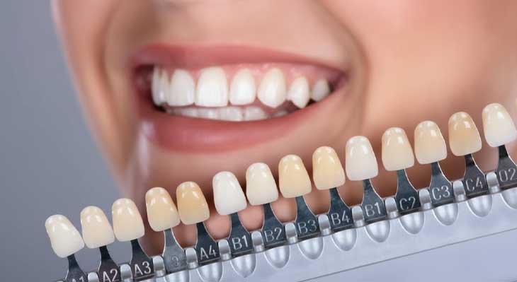 تفاوت رنگ لمینت دندان A و B