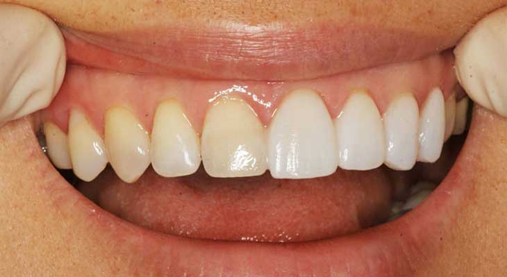 کامپوزیت بدون تراش دندان